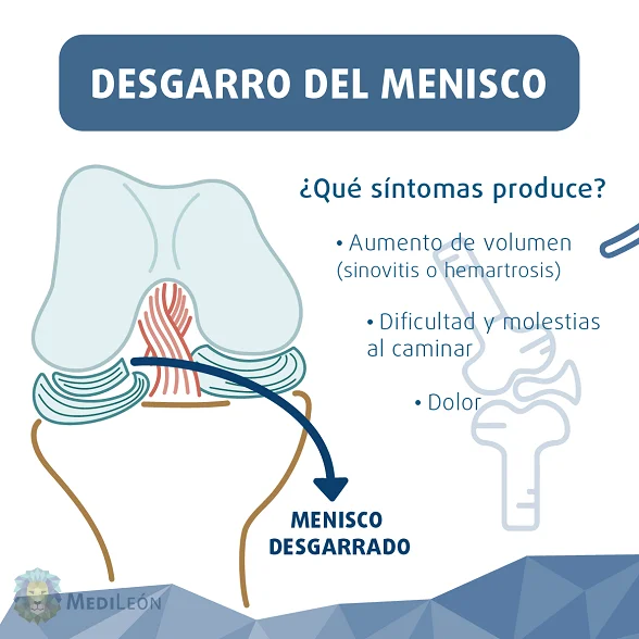 desgarro o rotura de menisco de rodilla