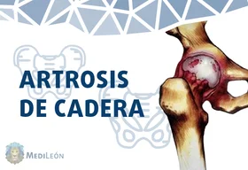 dolor de cadera con artrosis grados