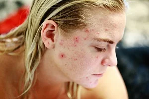 acne mujer con acne vulgaris acne comun acne cistico papulas pus